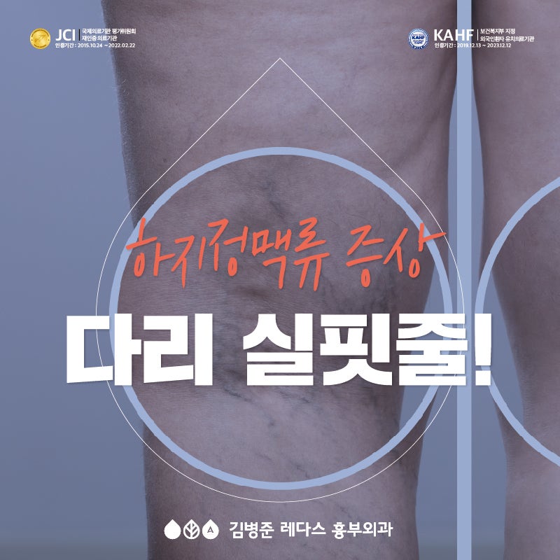 [부산 하지정맥] 다리 실핏줄! 하지정맥류 증상?