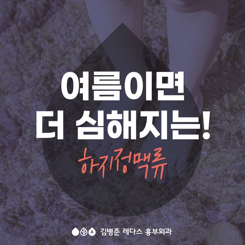 여름이면 더 심해지는 하지정맥류 증상