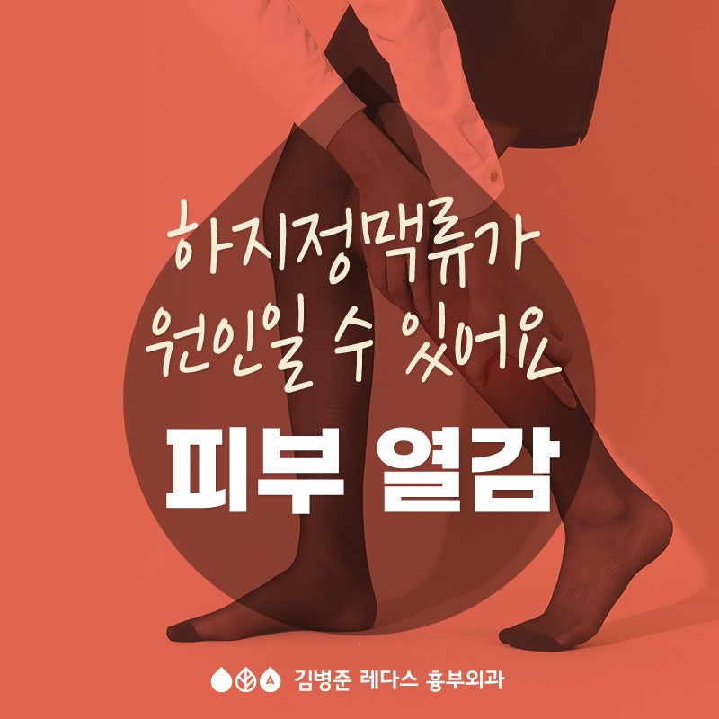 [부산 하지정맥] 피부 열감! 하지정맥류가 원인일 수 있어요!