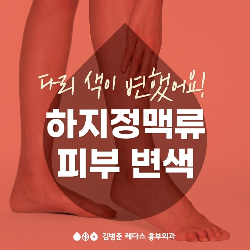 다리 색이 변했어요 - 하지정맥류와 피부 변색(색소침착)