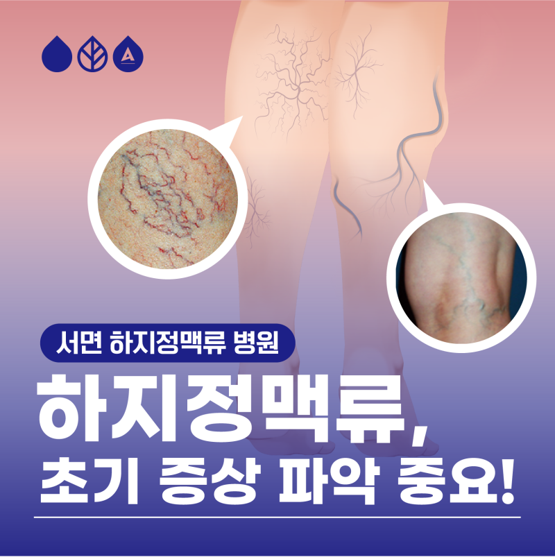서면 하지정맥류 초기 증상 파악이 중요합니다