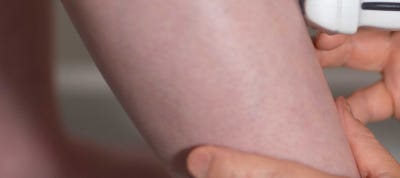 서면 하지정맥류 초기 증상 파악이 중요합니다 사진 12