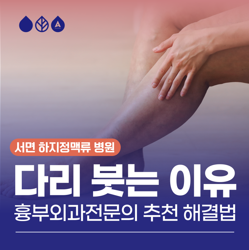 다리가 붓는 이유와 의사 추천 해결법