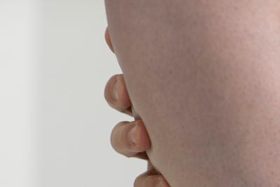 하지정맥류 생기는 혈관 다리정맥 사진 9