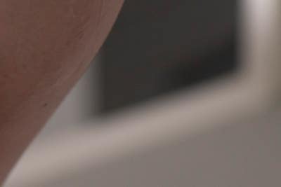 종아리 통증 오래 방치했다면, 하지정맥류 의심해보세요 사진 12