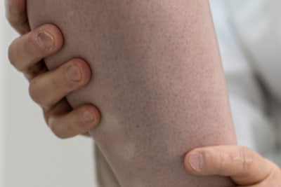 한쪽다리통증 피로 때문이 아닌 하지정맥류 증상? 사진 10