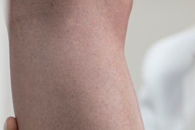 한쪽다리통증 피로 때문이 아닌 하지정맥류 증상? 사진 7