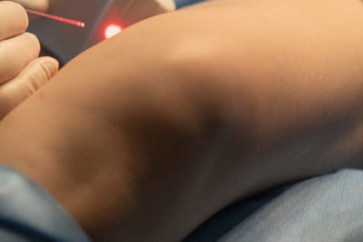 하지정맥류 원인, 관통정맥 부전 사진 16
