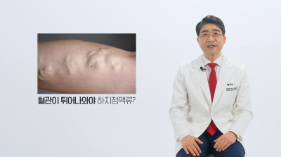 눈에 보이지 않는 잠복성 하지정맥류 확인 사진 3