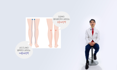 눈에 보이지 않는 잠복성 하지정맥류 확인 사진 5