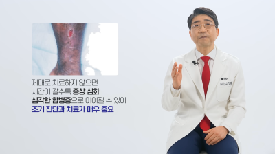 하지정맥류 당장 치료가 어렵다면, 약물? 압박스타킹? 사진 6