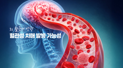 하지정맥류 있으면 치매 잘 생긴다? 논문 확인해보세요 사진 12