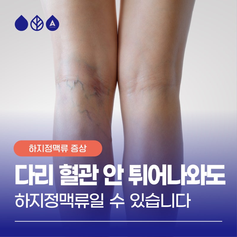 부산하지정맥, 혈관 안 튀어나와도 환자들이 진짜 호소하는 증상
