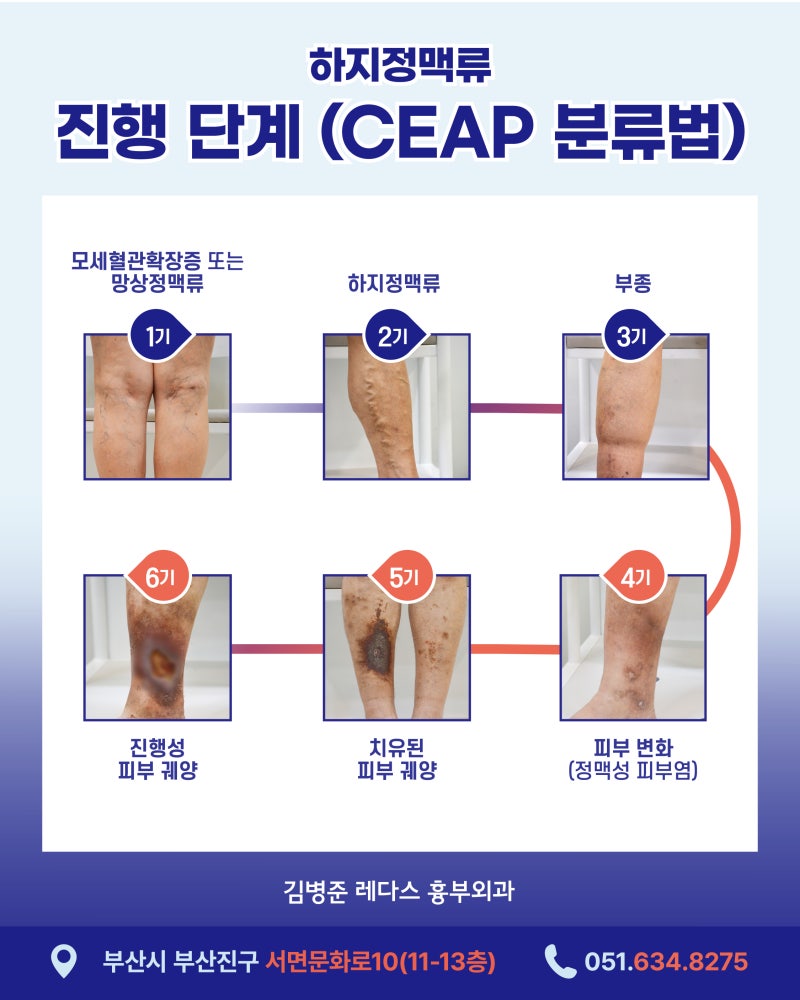 부산 하지정맥류, 초기 증상 확인하세요 사진 4