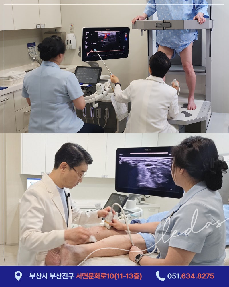 [KNN 건강365] 김병준 원장의 하지정맥류 비수술 치료, 주사치료