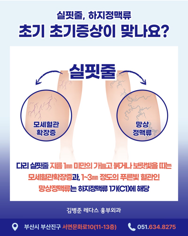 다리 실핏줄이 하지정맥류 1기? 초기 증상을 확인해보세요 사진 3