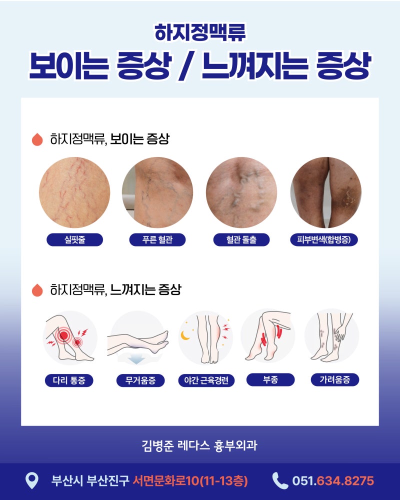 다리 실핏줄이 하지정맥류 1기? 초기 증상을 확인해보세요 사진 4