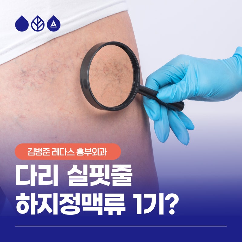 다리 실핏줄이 하지정맥류 1기? 초기 증상을 확인해보세요
