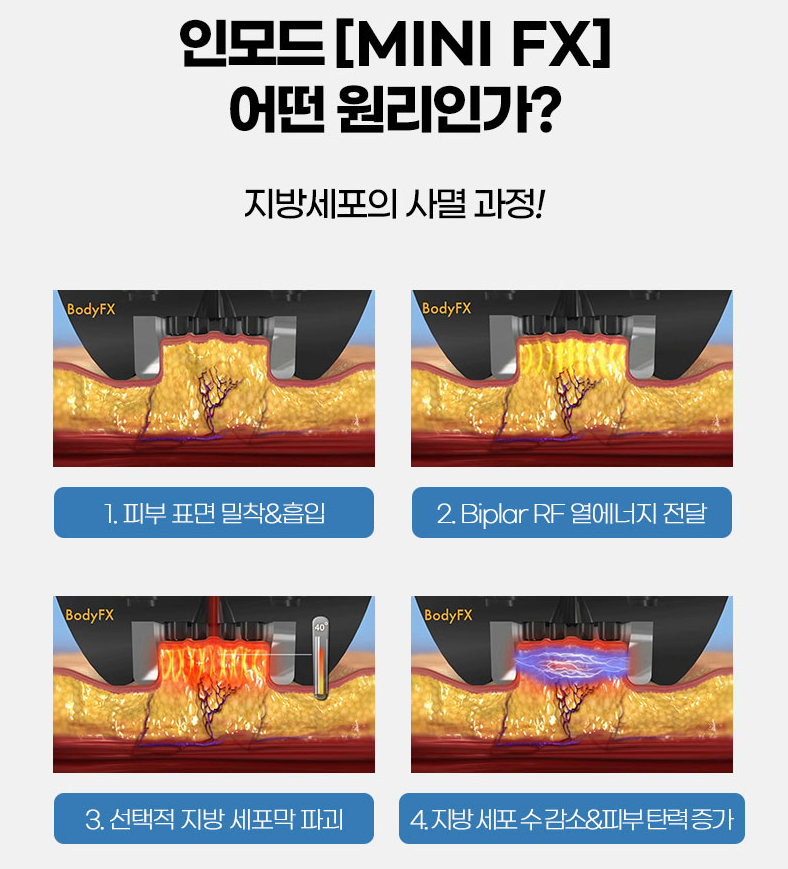 인모드 3단계? 원장님이 직접 시술합니다 사진 4