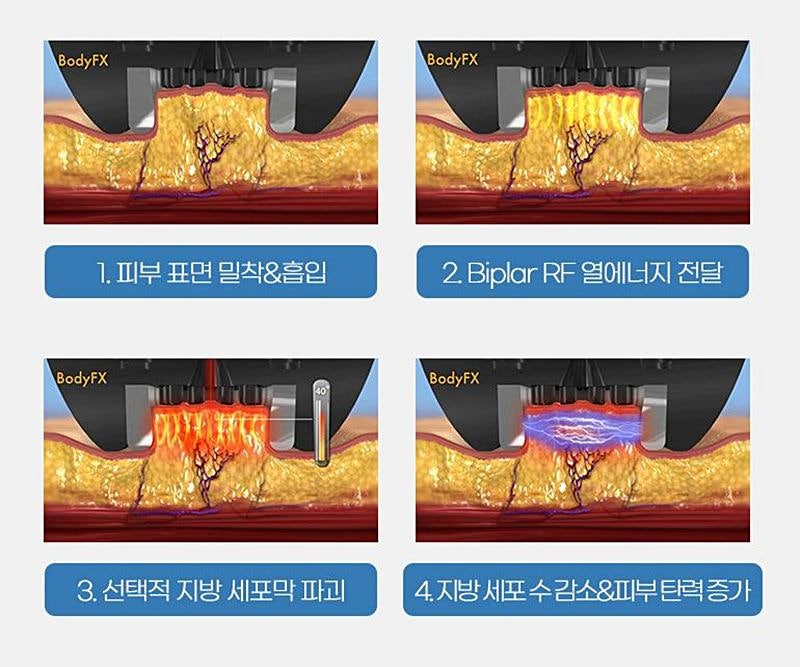 인모드효과 어떻게 좋을까? 사진 3