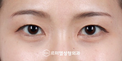수험생 눈성형 2024 수능 이벤트 사진 5
