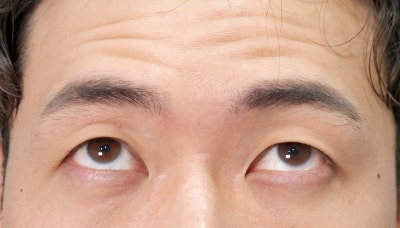 남자 절개 눈매교정? 돈 버리지 마세요