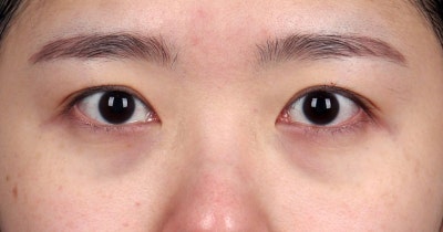 눈밑고랑필러 추천하지 않는 이유