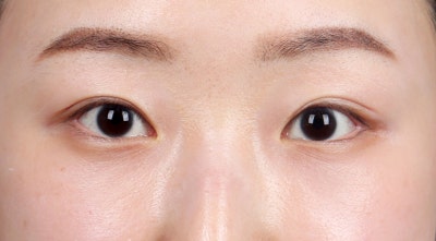 과거 눈밑지방이식 후 제거한 사례