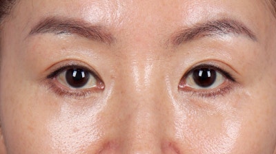 중년눈성형 하안검? 재배치? 고집할 필요 없습니다