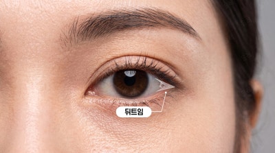 뒤트임 밑트임 흉터 많이 남을까요? 회복기간과 유의사항 정리
