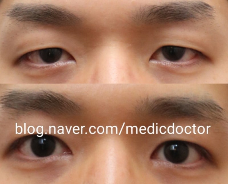 男士眼提肌矫正前后对比照 - 按类型分类