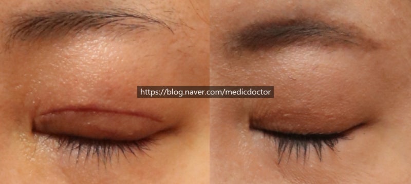 切开法眼提肌手术会留下明显的双眼皮疤痕吗？