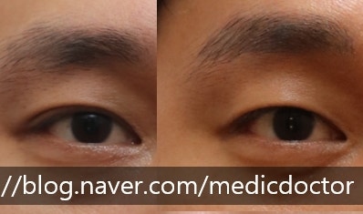 消除双眼皮手术：打造单眼皮效果的方法