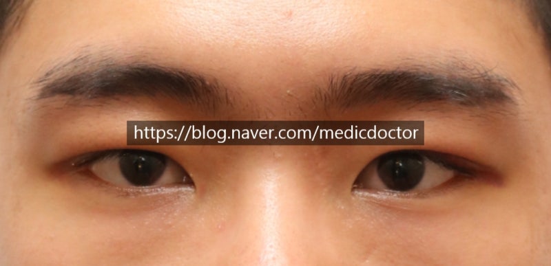 男士眼提肌手术消肿过程：1周、1个月对比视频
