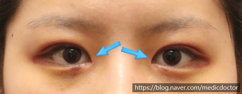 切开法眼提肌矫正后记：即使搭配开内眼角，肿胀也不严重