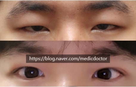 비절개 눈매교정 부작용. 매몰법 하면 안되는 케이스