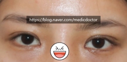 切開提肌矯正鬆解 早期矯正的情況 - 快速重修（預防併發症）