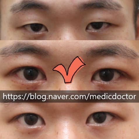 男性无双眼皮眼睑下垂矫正术后肿胀恢复（不显双眼皮）