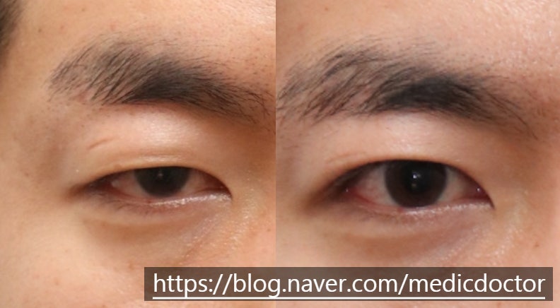男性非切开眼睑下垂矫正不适合的原因和副作用