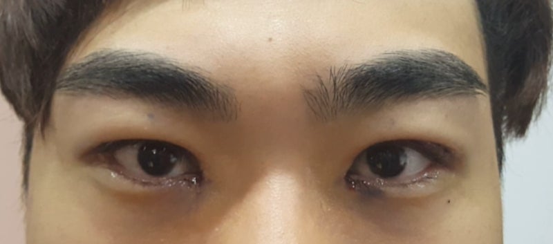 男士单眼皮眼型矫正：手术前与术后当天的对比（含三白眼矫正）