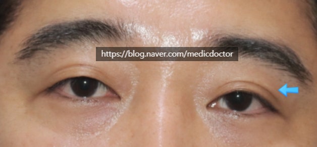 男性双眼皮消除手术治验例：双眼皮去除手术