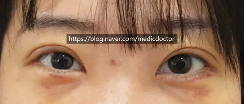 Зүсэлттэй нүдний хэлбэр засах мэс заслын 1 долоо хоногийн дараах хаван (Өнөөдөр оёдол авхуулсан тохиолдол)