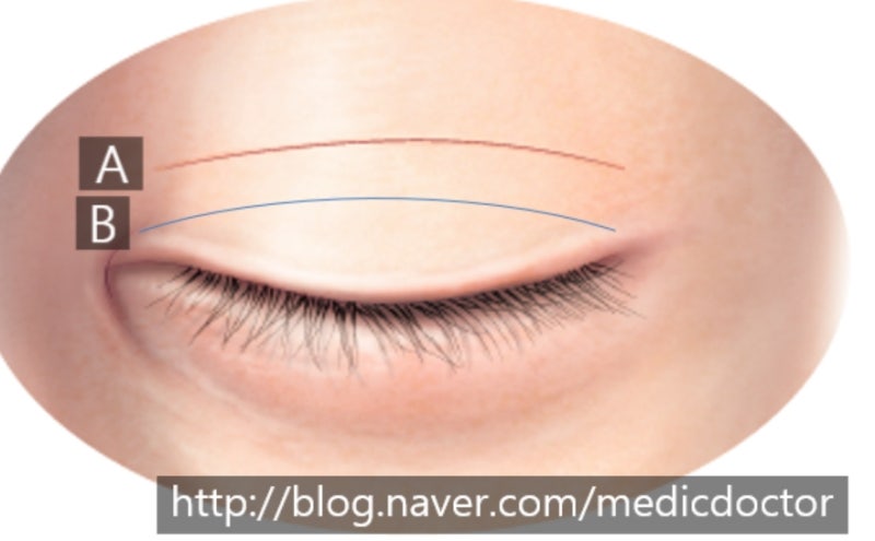 The Choice Between Double-Line and Single-Line Incisions and Examples of Early Correction