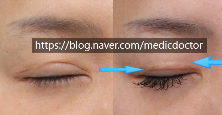 Misconceptions About Double-Fold Lowering (Skin-Sparing) Scars, Low Crease Scars, and Incisional Double Eyelid Scars (feat. Deep Fixation?)