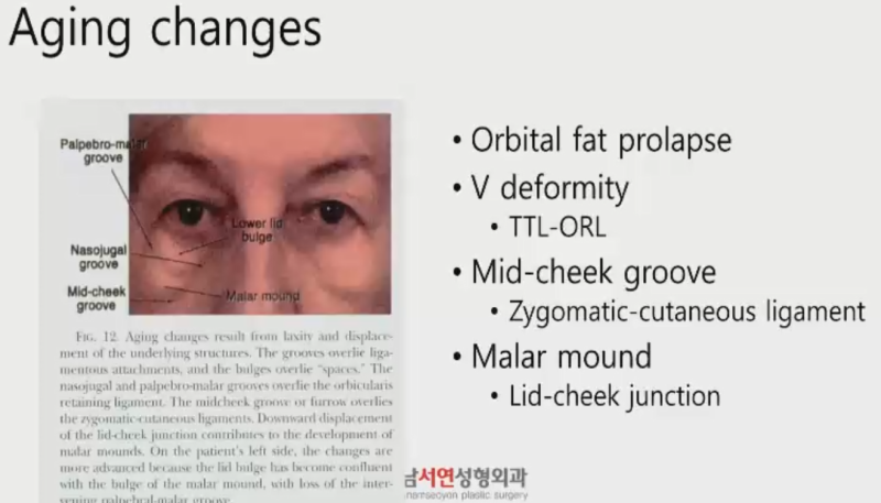 Under-Eye Fat Repositioning Lecture: EZ-Tcon Webinar Sponsored by HansBiomed (Dark Circles, Under-Eye Fat, Lower Blepharoplasty)