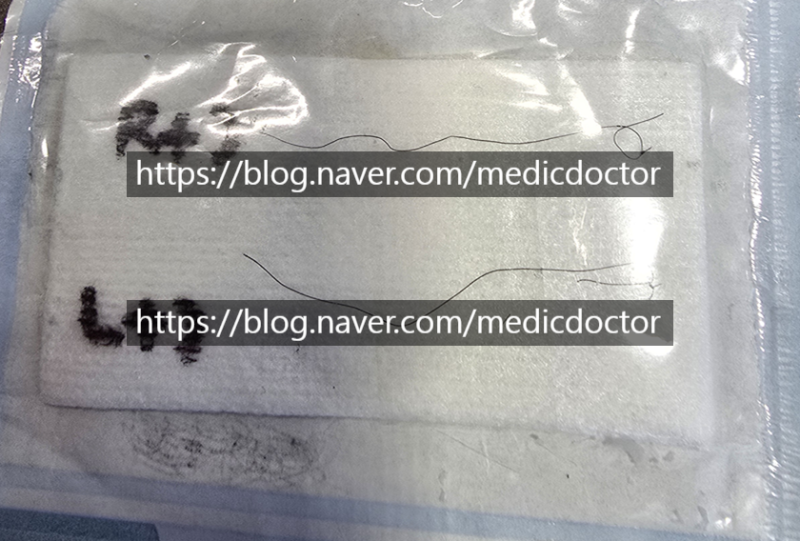 解開自然黏合雙眼皮：為何多結法難以拆除