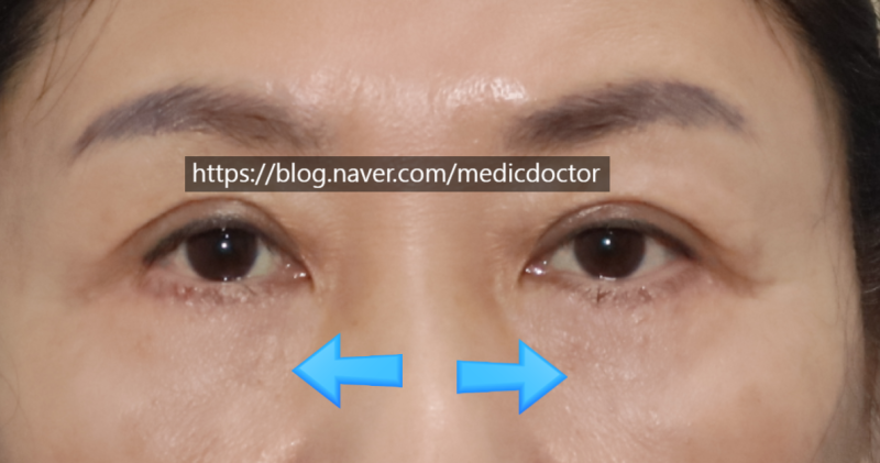 상안검 수술 하안검 수술 같이해도 되요?