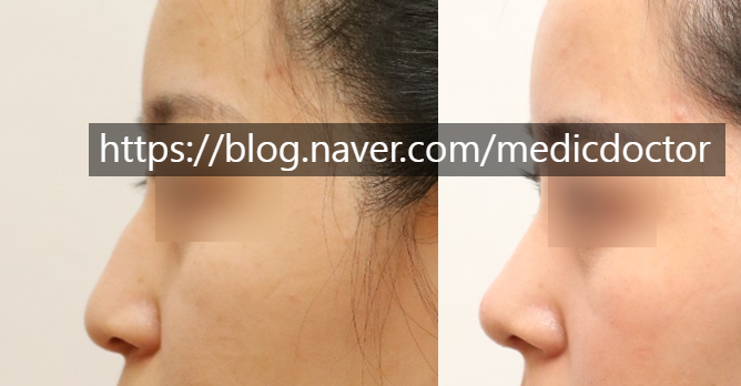 Nose Lengthening Surgery - Physiognomy-Based Nose Line Correction