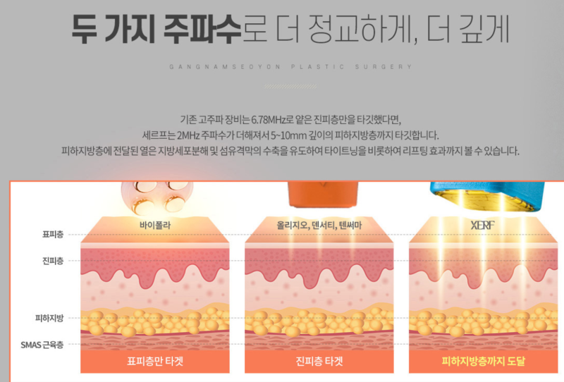 세르프(XERF) 리프팅 시술 주기 안내