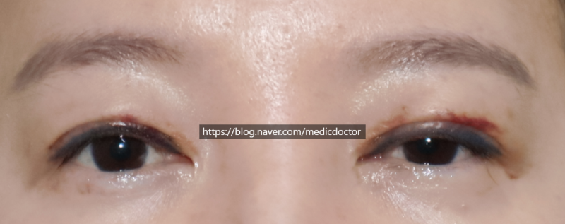Early Revision of Ptosis Correction and Upper Eyelid Fat Grafting: A Case Study